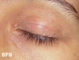nail polish dermatitis