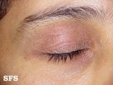 nail polish dermatitis