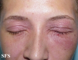 nail polish dermatitis