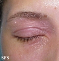 nail polish dermatitis
