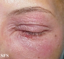 nail polish dermatitis