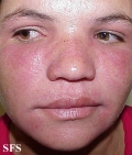 nail polish dermatitis