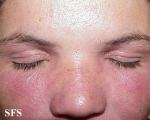 nail polish dermatitis