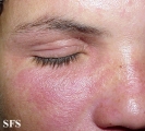 nail polish dermatitis