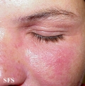nail polish dermatitis
