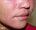 nail polish dermatitis