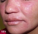 nail polish dermatitis