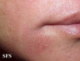 nail polish dermatitis