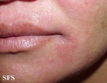 nail polish dermatitis