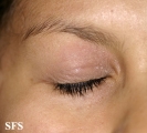 nail polish dermatitis