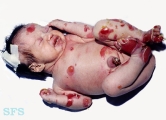 epidermolysis bullosa dystrofic recessive