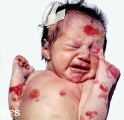 epidermolysis bullosa dystrofic recessive