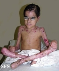epidermolysis bullosa dystrofic recessive