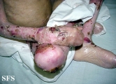 epidermolysis bullosa dystrofic recessive