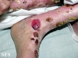 epidermolysis bullosa dystrofic recessive