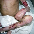 epidermolysis bullosa dystrofic recessive