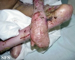 epidermolysis bullosa dystrofic recessive