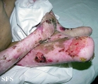 epidermolysis bullosa dystrofic recessive
