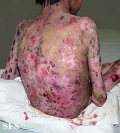 epidermolysis bullosa dystrofic recessive