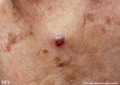 merkel cell tumours