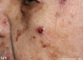 merkel cell tumours