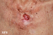merkel cell tumours
