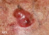 merkel cell tumours