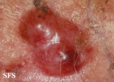 merkel cell tumours