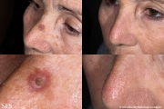 keratoacanthoma