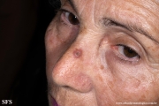 keratoacanthoma