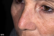 keratoacanthoma