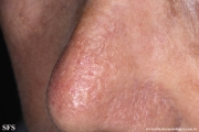 keratoacanthoma