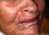 keratosis solar
