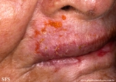 keratosis solar
