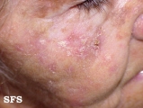 keratosis solar