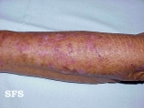 keratosis solar