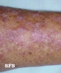 keratosis solar