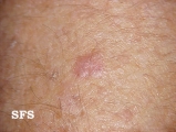 keratosis solar