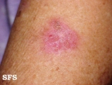 keratosis solar