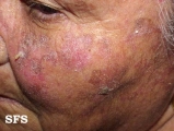 keratosis solar