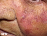 keratosis solar