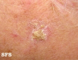 keratosis solar
