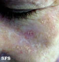 keratosis solar