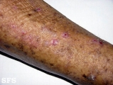 keratosis solar