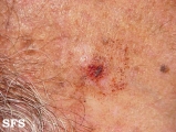 keratosis solar
