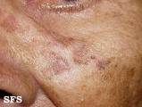 keratosis solar