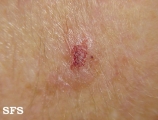 keratosis solar