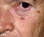 keratosis solar