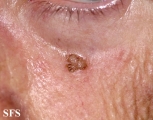 keratosis solar