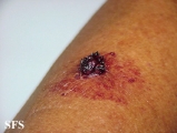 keratosis solar